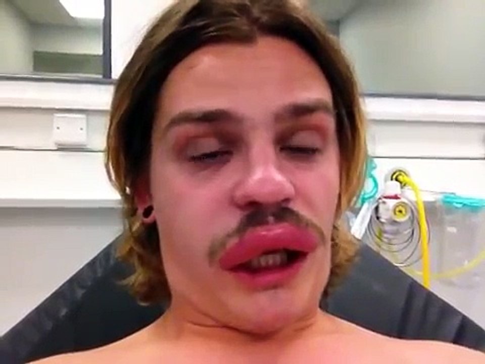 why pay for botox ? get an insect !