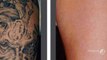 TattooRemovalToowoomba- Offers best tattoo removal service using specialized and effective tattoo removal laser in the world