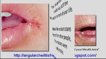 Angular Cheilitis Home Remedy - How to Cure Angular Cheilitis Free Forever Naturally  Permanently