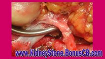 kidney stone remedy   male kidney stone removal   kidney stone