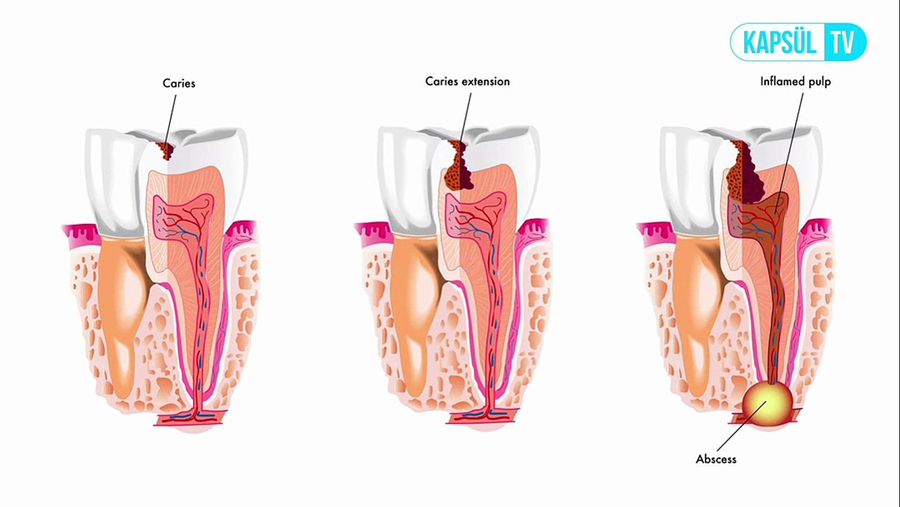 Diş Apsesi Nasıl Tedavi Edilir? Apseli Diş Çekilir Mi?