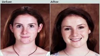 Acne No More Review WOW Acne No More