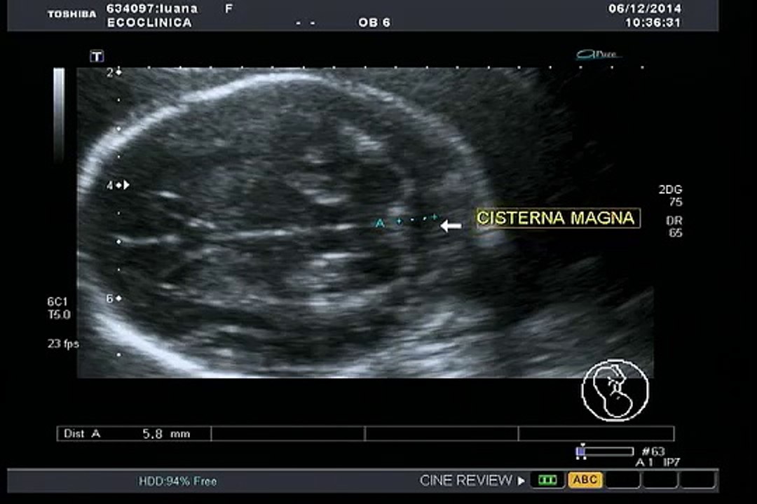 Ecografia Morfológica 22 semanas e 1d.