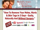 Moles, warts and skin tags removal home remedy in 3 Days