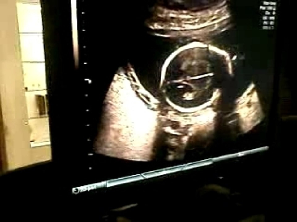 Ecografia/Ultrasound: 21 semanas