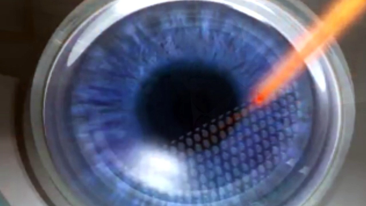 Intralase - Hudson Valley, Rockland County, Westchester County