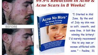 Acne No More   Acne Cure