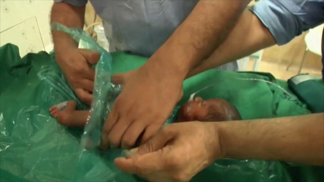 Des sacs plastiques pour sauver les prématurés