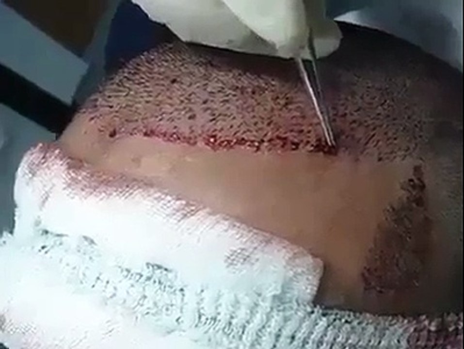 سر کے بال دوبارہ اس طرح لگائے جاتے ہیں