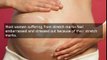 Bio-Oil Tips From Real Mums - Helps To Reduce Post Pregnancy Stretch Marks