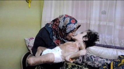 Hidrosefali Hastası Çocukları İçin Yardım Bekliyorlar