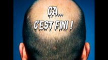 Terminé la calvitie ? Test en direct !!