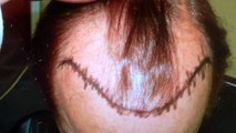 Bald Hairline Hair Loss Transplant Surgery Result Dr. Diep www.mhtaclinic.com 1 Year Follow Up