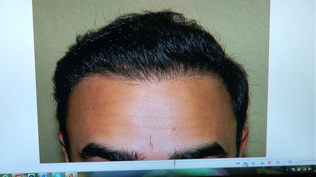 Man Hair Loss Transplant Restoration Surgery Dr. Diep mhtaclinic.com