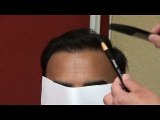 Man Bald Hair Loss Transplant Restoration Surgery Treatment 1 Year Follow Up Result Dr. Diep www.mhtaclinic.com Bay Area California