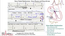 8-2 Sinus Pauses and Arrest