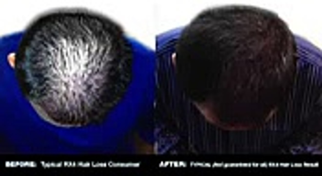 Rx 4 Hair Loss Natural and Organic Restoration Scalp Cream for Men and Women