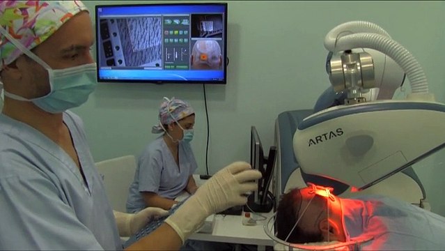 Artas, el robot anticalvicie