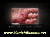 Buy Cure Child Eczema you are searching for