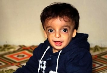 Küçük Ahmet'in 18 Bin Liralık İşitme Cihazı Çalındı