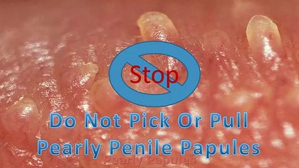 Pearly Penile Papules Removal Methods (pearly penile papules)