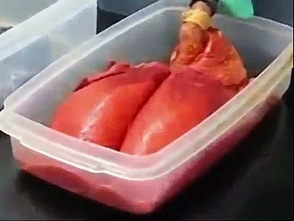 Comparison between normal lungs with smoker's lung