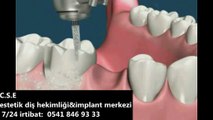 METAL DESTEKLİ PORSELEN