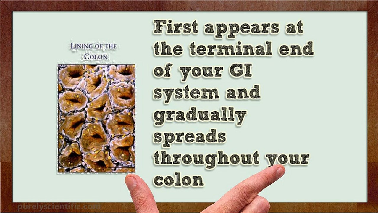 Can Digestive Enzyme Treat My Ulcerative Colitis?