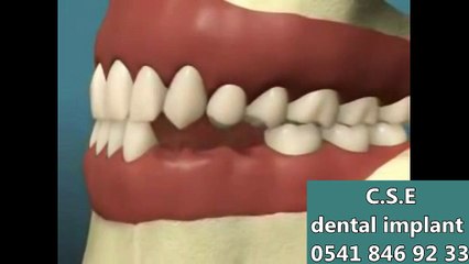 implant diş yapımı