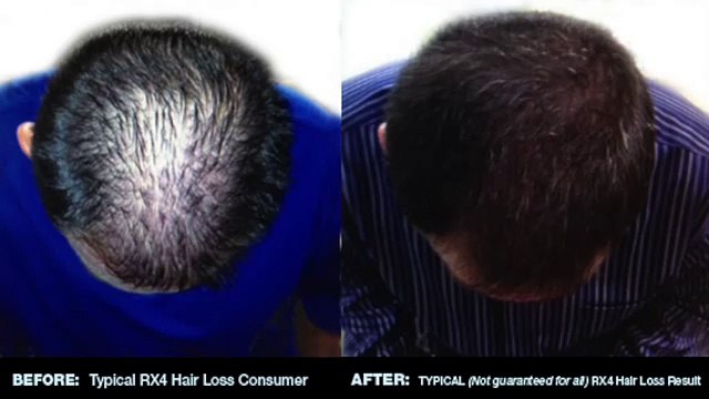 Rx 4 Hair Loss Natural and Organic Conditioner for Men and Women