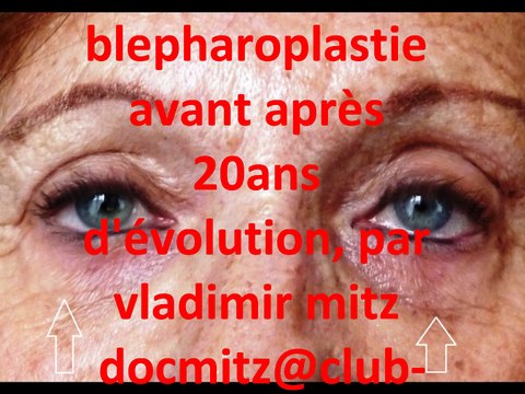 poches sous les yeux,avant apres par docmitz