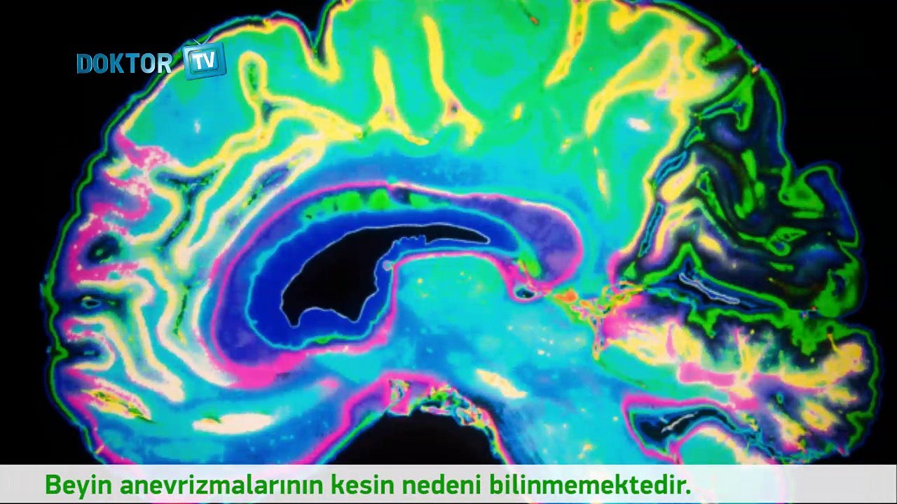 Beyin anevrizması nedir?