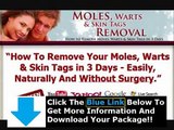 Moles Warts Skin Tags Removal Ebook   Moles Warts Removal