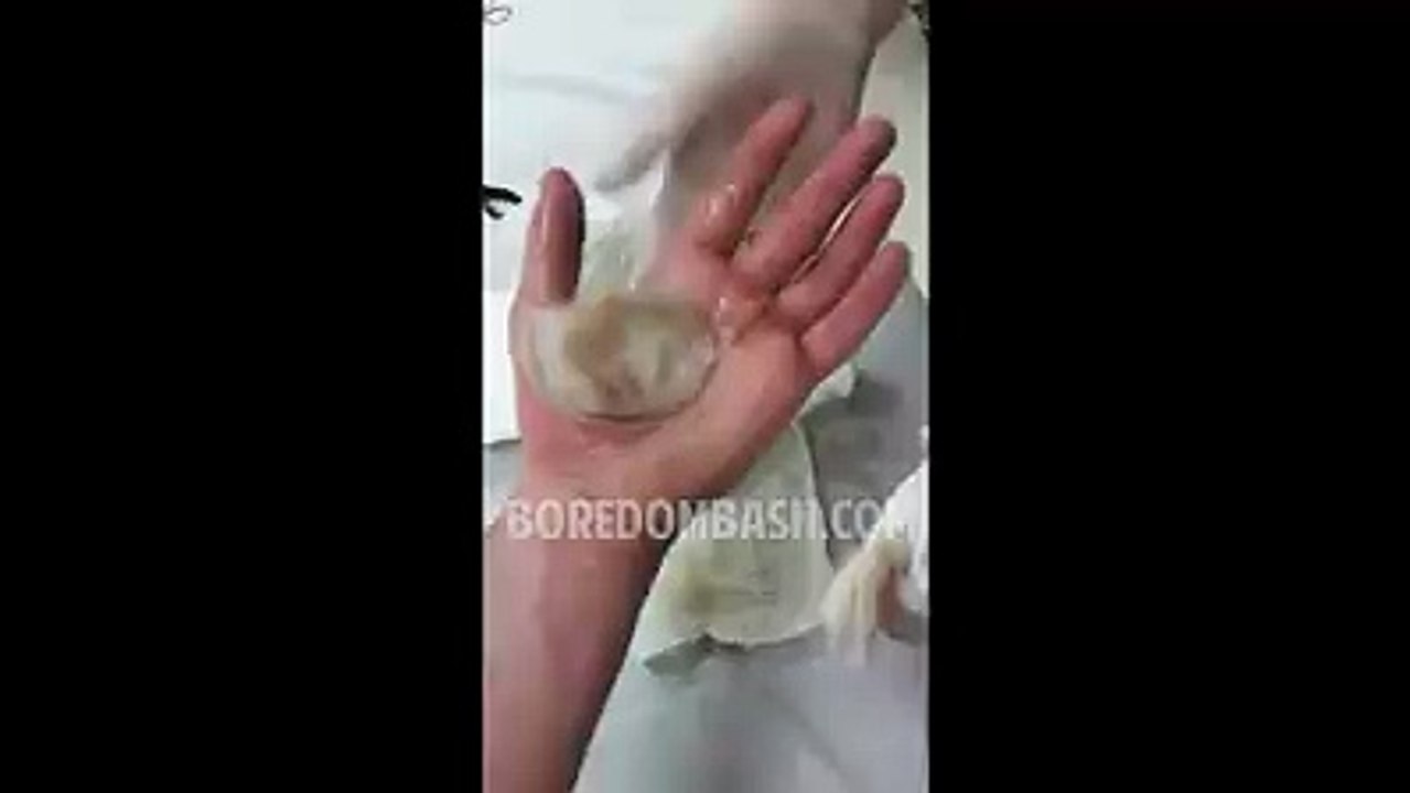 Nasty hand swell