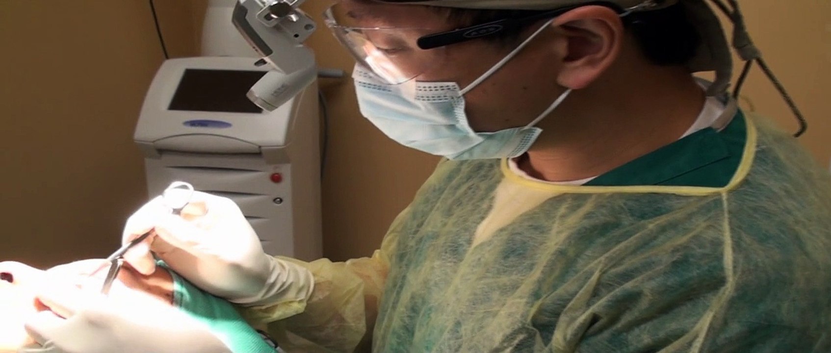 Acne Scar Revision Part 03 Excisional Technique Dr. Young Bellevue Seattle