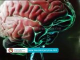 Aneurysm Coliling Surgery Hyderabad Cerebral Repair Andhra Pradesh