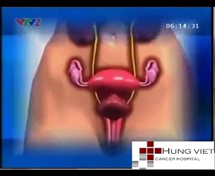 Ung thư cổ tử cung nguyên nhân, triệu chứng, cách điều trị - BVUB hưng việt số 34 đại cồ việt