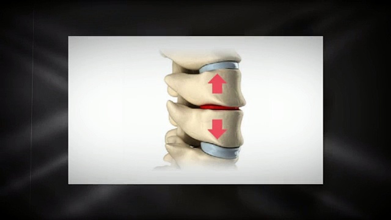 Inversion Treatment Of Low Back Pain Using Inversion Table