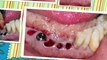Dental Implants surgery procedure India, extraction implants and permanent teeth punjab jalandhar