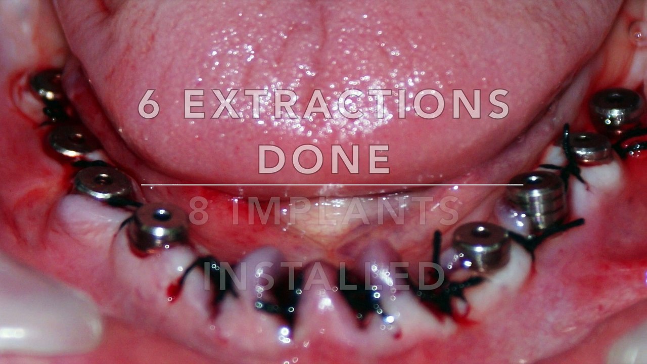 India dental implants surgery procedure all on 4, all on 8, jalandhar punjab, extraction of teeth implant placement and permanent teeth, international patient dental tourism, ludhiana, chandigarh, computer guided implants