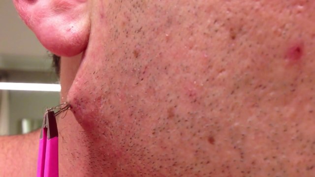 Horrible pimple : The Longest Grossest Ingrown Hair In History