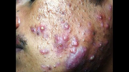 Acne Treatment - Acne No More