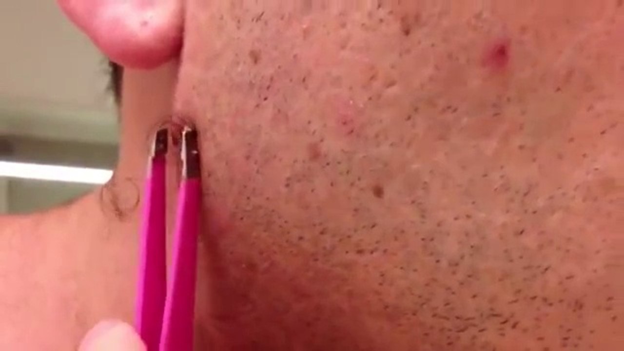 Un homme s'enlève un poil et découvre que ce n'est pas un simple poil