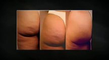 Ejercicios Para Eliminar Las Celulitis- Celulitis Nunca Mas La Cura Natural