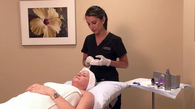 Chemical Peel for Wrinkles and Sun Damage in Connecticut at Jandali Plastic Surgery