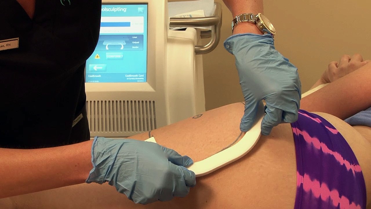 CoolSculpting of the Outer Thigh Fat & Saddlebags in Connecticut at Jandali Plastic Surgery