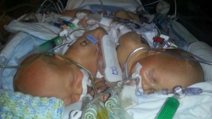 Conjoined Twins In Florida Survive Their First Surgery