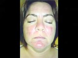 Using Photofacial (Pulsed Light or IPL) technology to treat rosacea