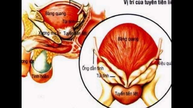 Ung thư tuyến tiền liệt - By BVUB Hung Viet