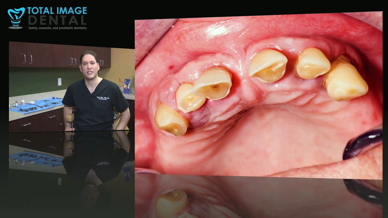 Replacing My Worn Teeth In Houston, TX